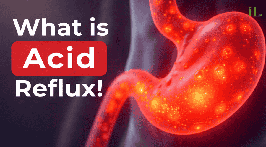 What is Acid Reflux